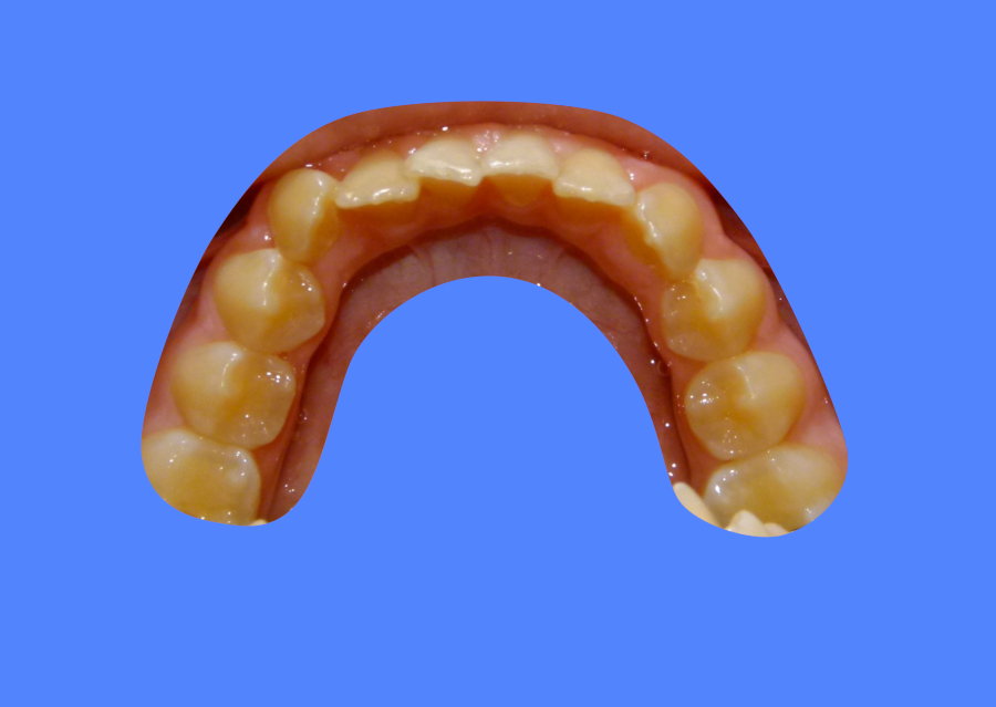 Before image showing patient with misaligned teeth